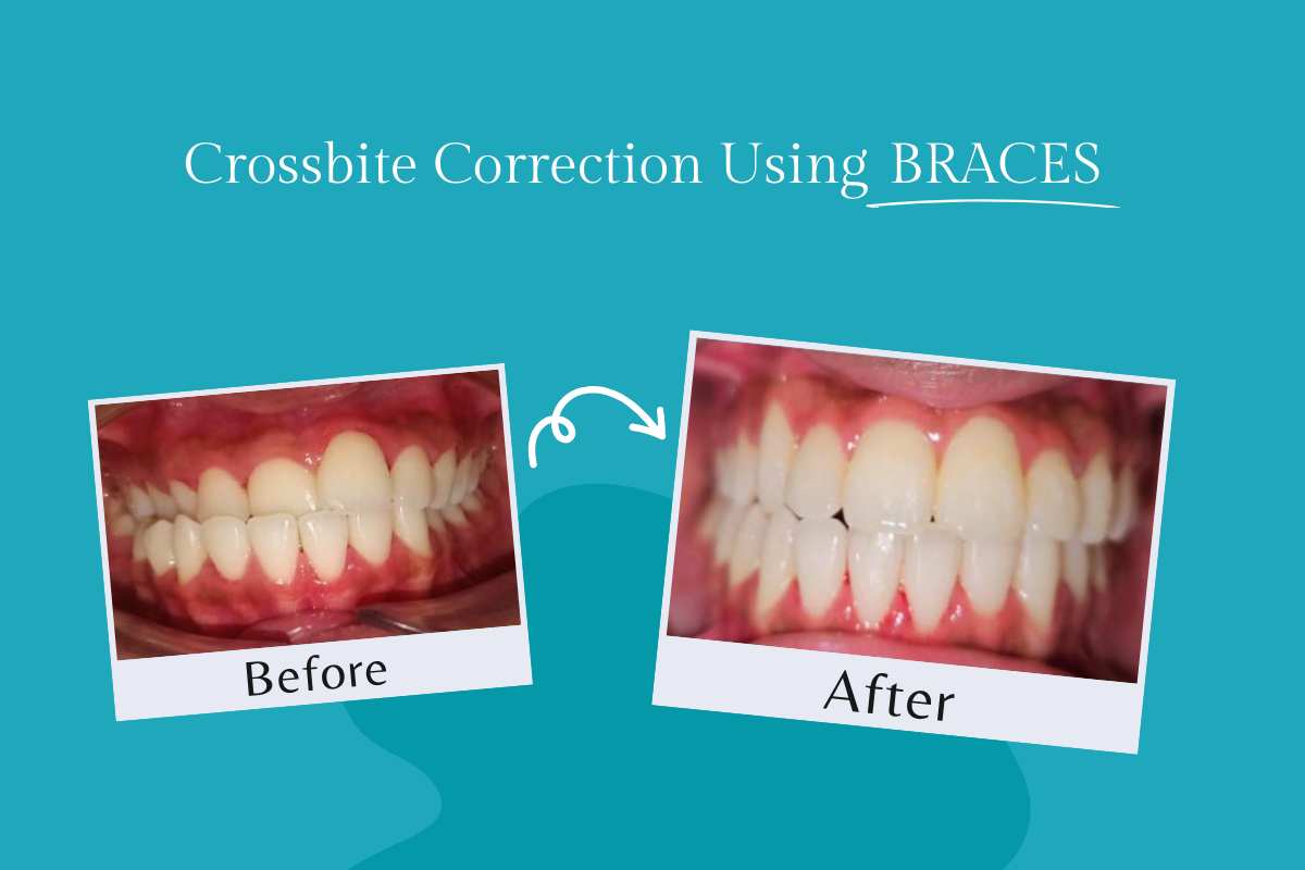 Braces Treatment