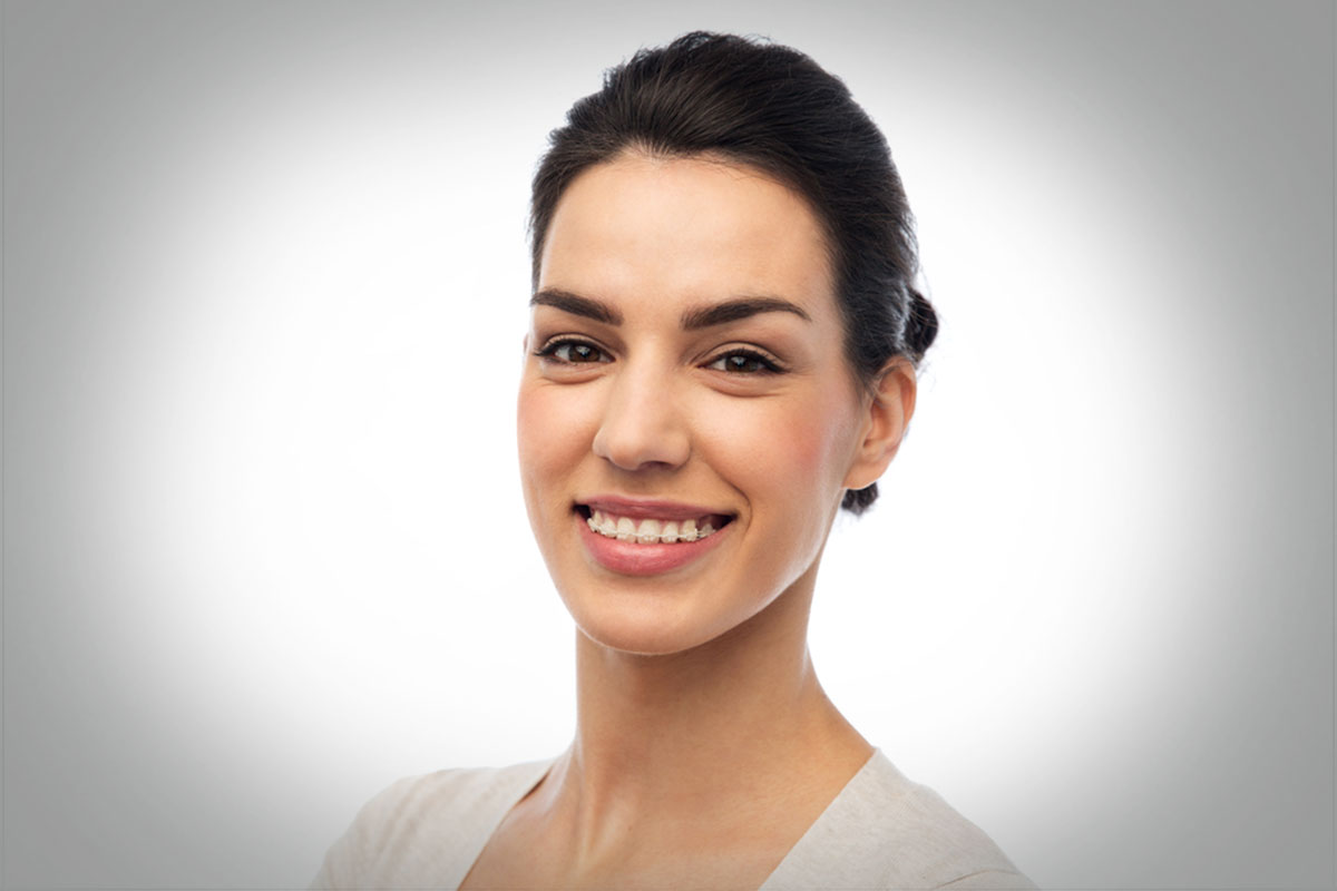 Ceramic-Braces