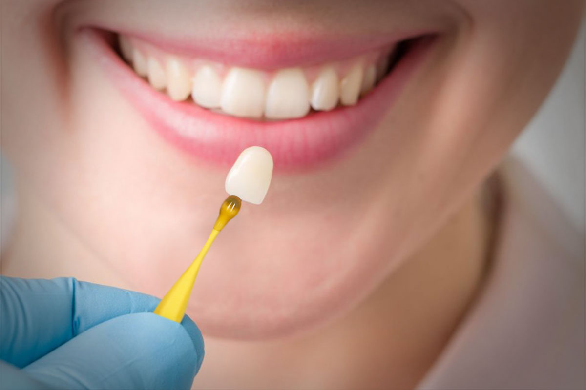 Dental-Veneers