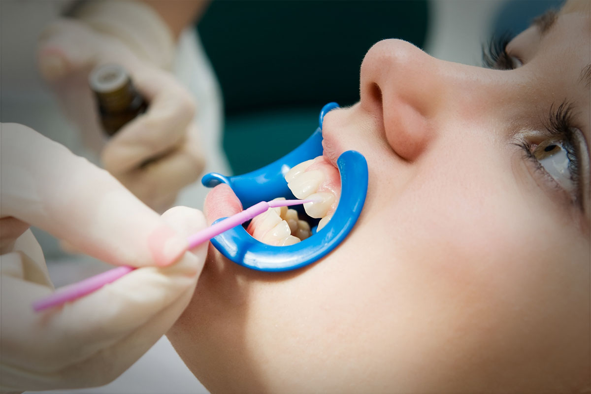 Fluoride-Application