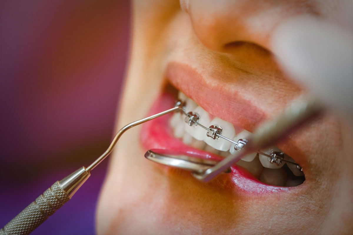 Self-Ligating-Braces